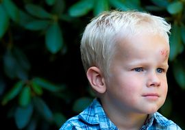 Kind mit einer Beule am Kopf